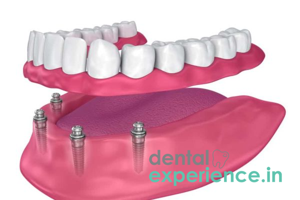 Overdenture