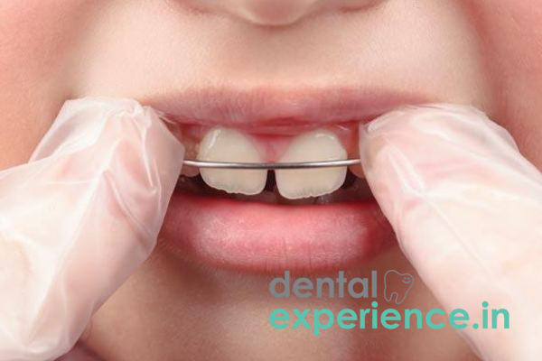 Early Braces Treatment for Malocclusion