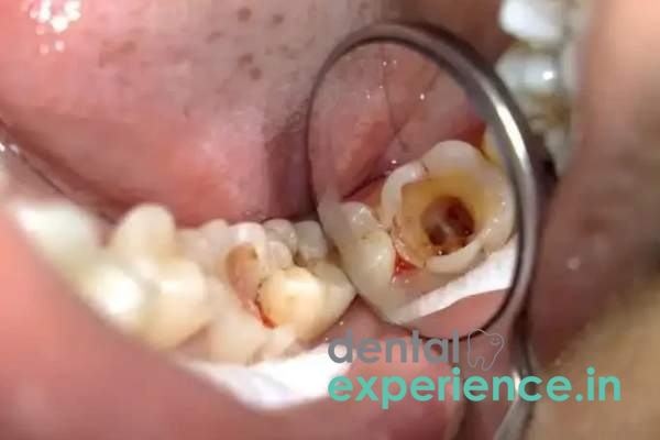 Pulpectomy