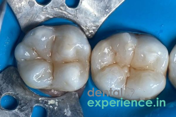 Direct composite resin restoration