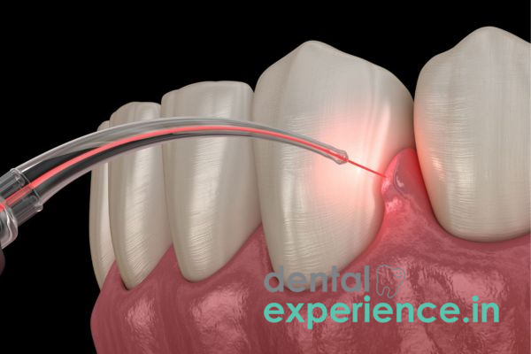 Gingivectomy (Gingivoplasty)
