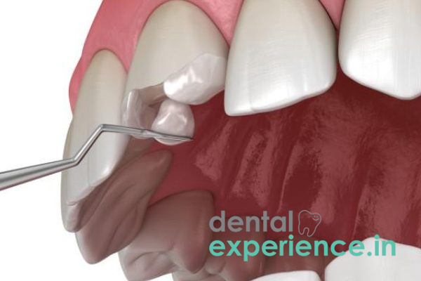 Repair of Chipped/ Broken Filling