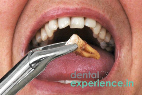 Extraction (Non-Surgical)