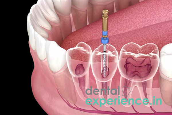 Root Canal Treatment