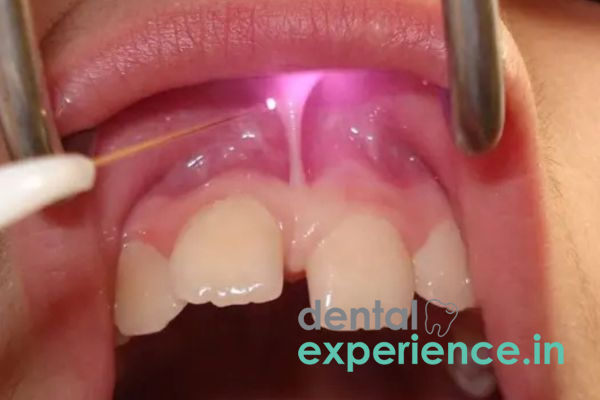 Frenectomy- Surgical/Laser