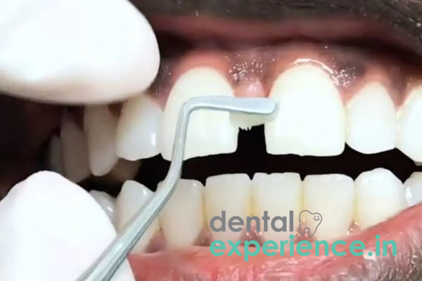 Teeth Gap Closure