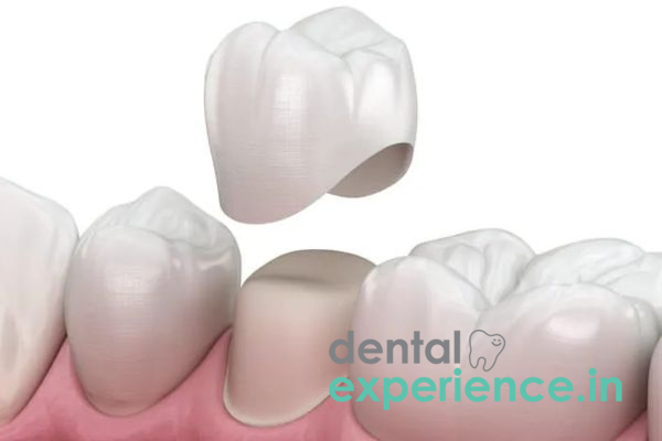 Metal Free Dental Crowns