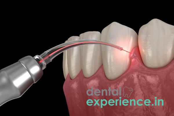 Cosmetic Gum Contouring Laser