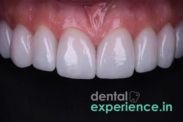 Dental Veneers/Laminates
