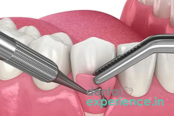 Periodontal Flap Surgery