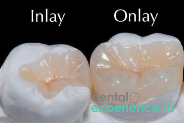 Inlay/ Onlay