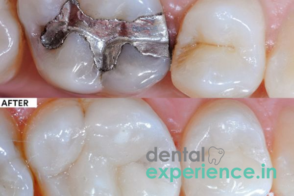 Amalgam Replacement