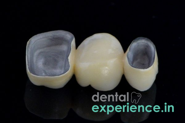 Metal Fused Ceramic Dental Bridge