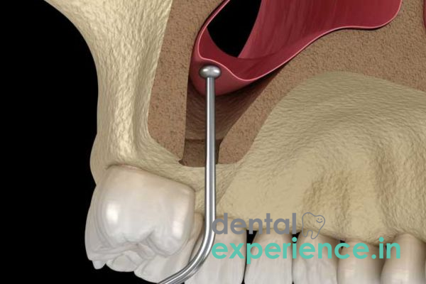 Sinus Lift Surgery