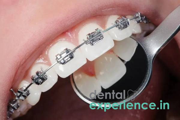 Clear Orthodontic Braces