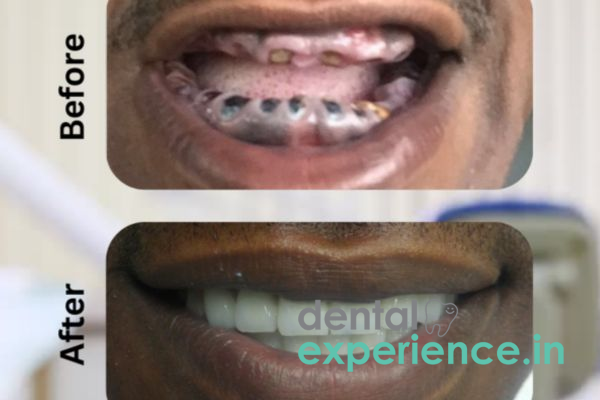 Full Mouth Rehabilitation