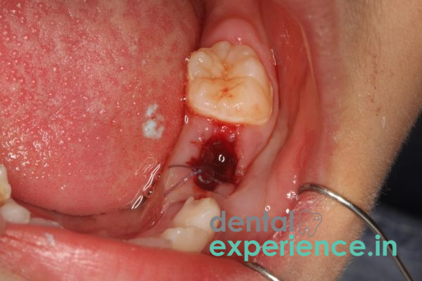 Cyst/ Abscess removal