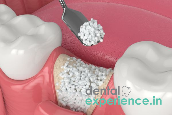 Bone Grafting