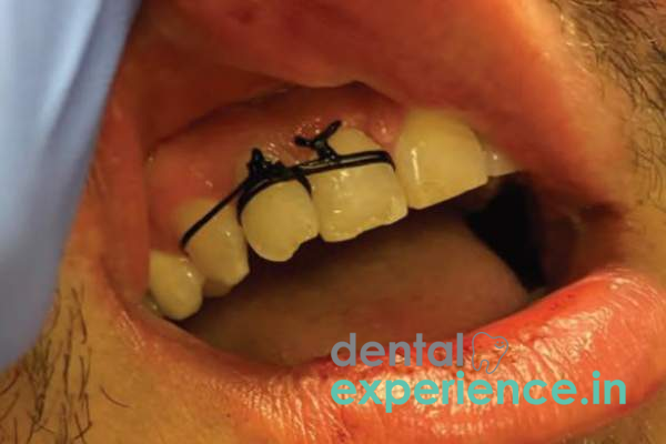 Emergency Tooth Trauma Management (Replantation of Avulsed Teeth)