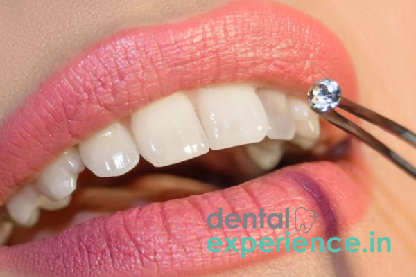 Dental Jewelry
