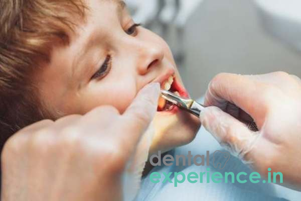 Early Extraction of Primary Teeth (For Permanent Tooth Alignment)