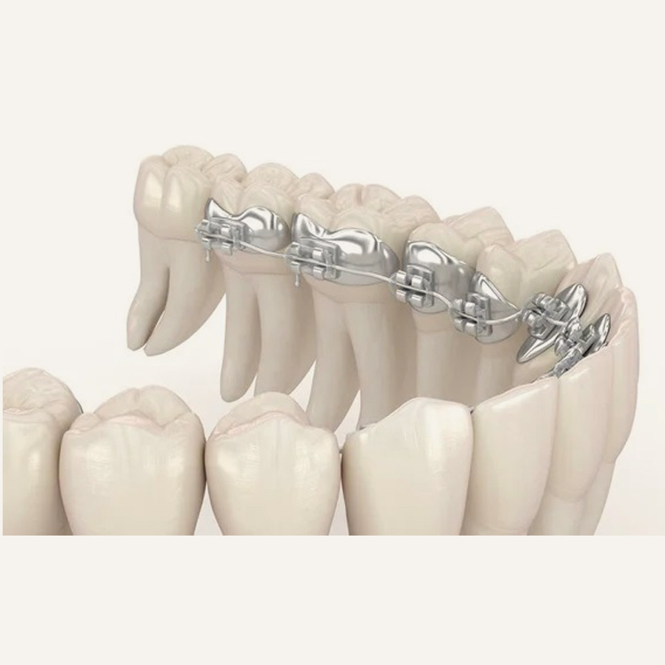 Lingual Invisible Braces